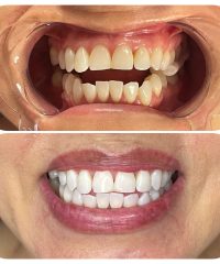 Dientes antes y despues